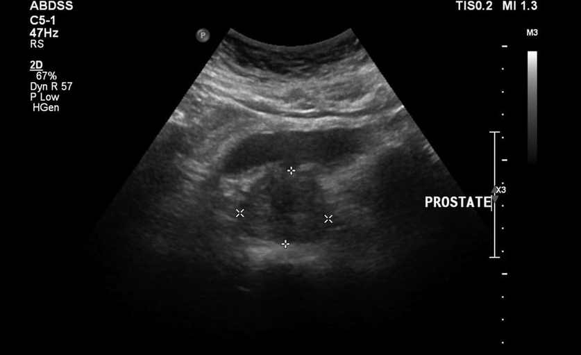 Ultrasound prostatitis before taking zxcvbnmqwert