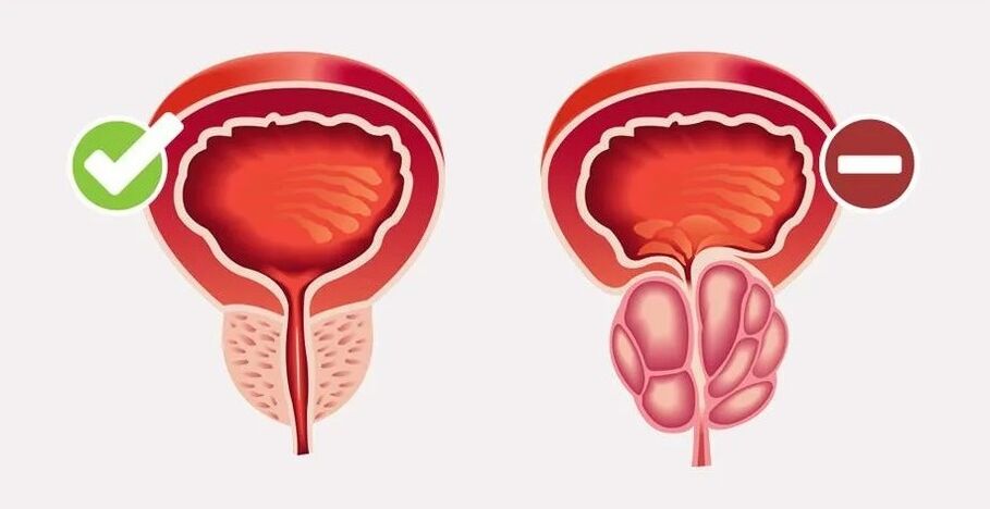 Prostatitis in men