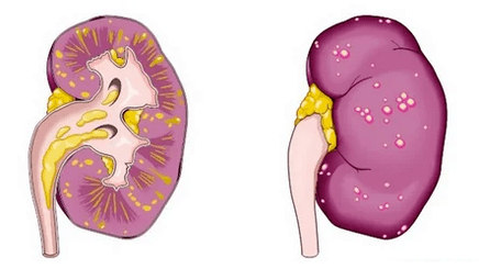 What acute prostatitis leads to