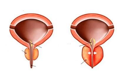 What is acute prostatitis