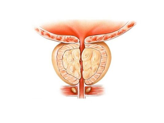 Increase in prostate with prostatitis