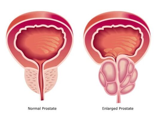 Normal and extended prostate
